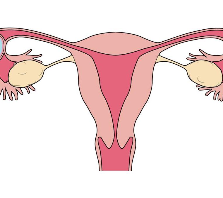 Ectopic pregnancy