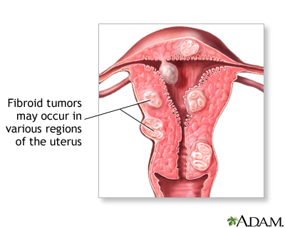 Uterine fibroid